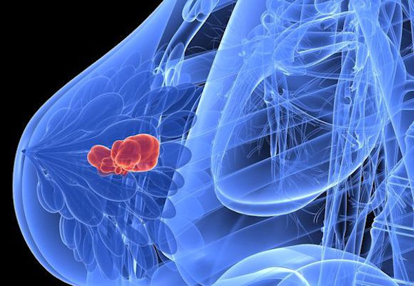 3d rendered illustration of a transparent female brest with tumor Kanceri i gjirit